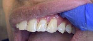 Front Tooth Filling. Beautiful Smile